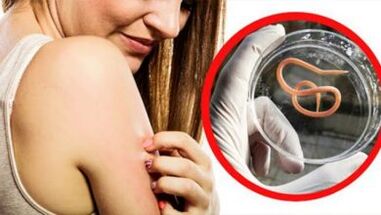 Une éruption cutanée sur le corps est un signe d'infection helminthique.